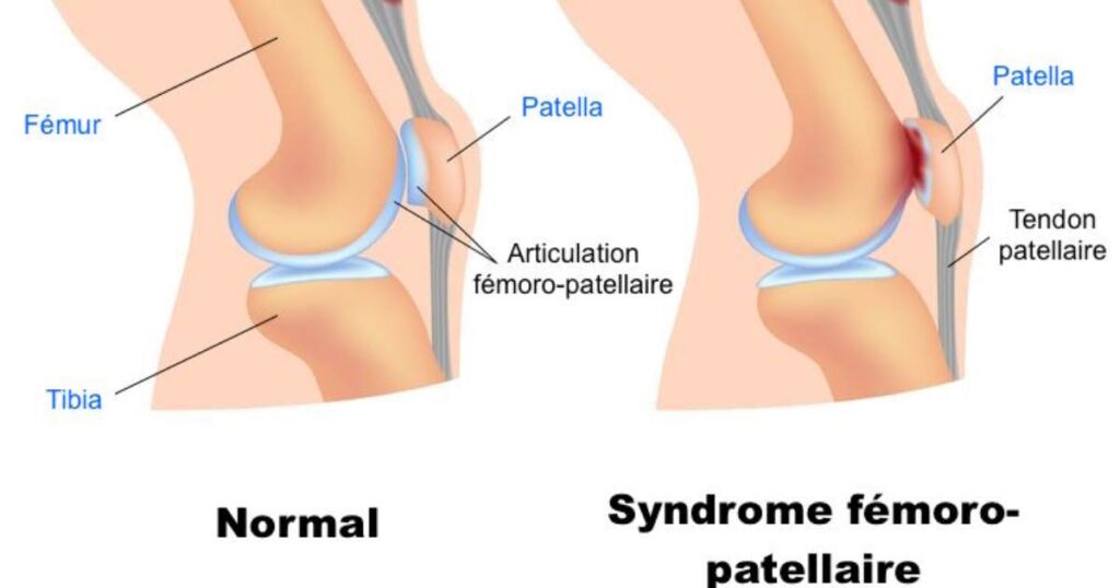 douleur au genou causée par la course à pied